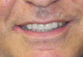 Cerec Crowns